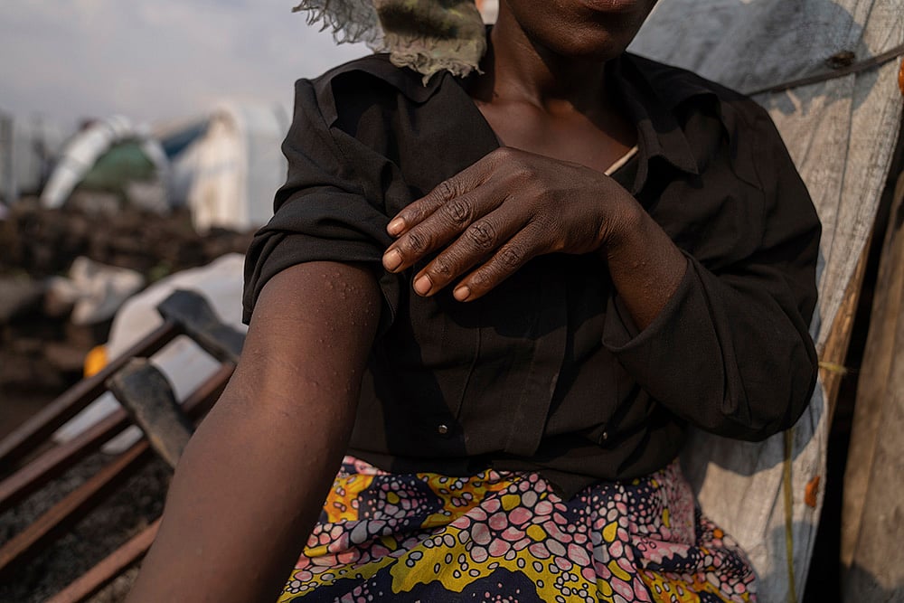 Congo Mpox: Sarah Bagheni, a suspected patient, in the Bulengo refugee camp in Goma. - | Photo: AP/Moses Sawasawa
